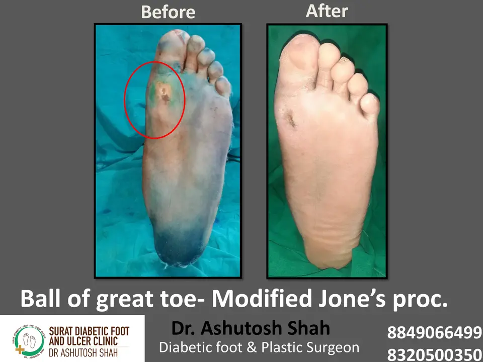 Diabetic Foot  PPT 3 checked by sir.pptx-40.webp